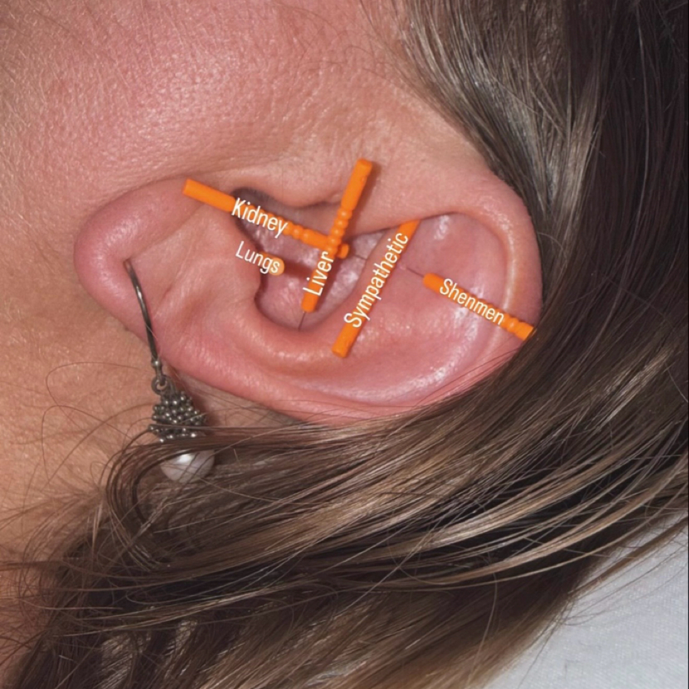 Ear Detox Acupuncture Session at RELAXING BRANDY Therapeutic Massage in Taylor, MI